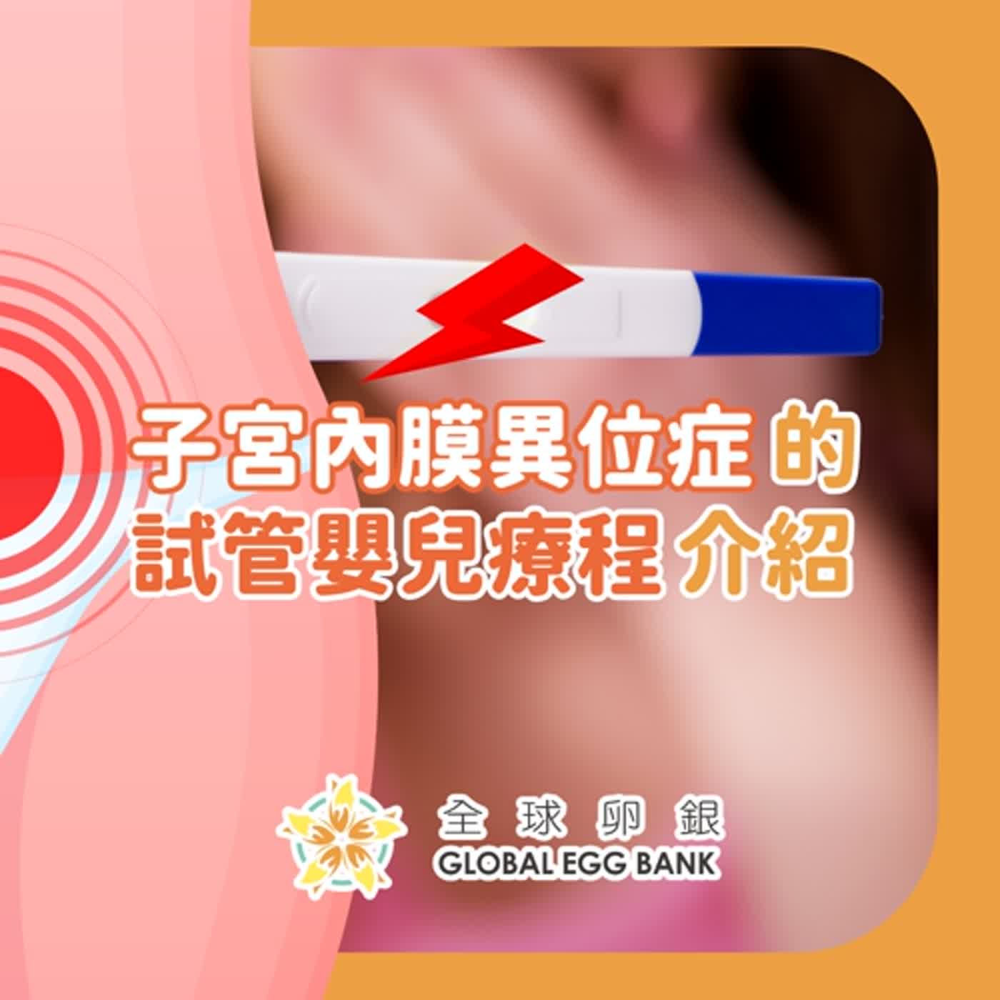 【好孕智多星Dr.IVF】子宮內膜異位症的試管嬰兒療程介紹