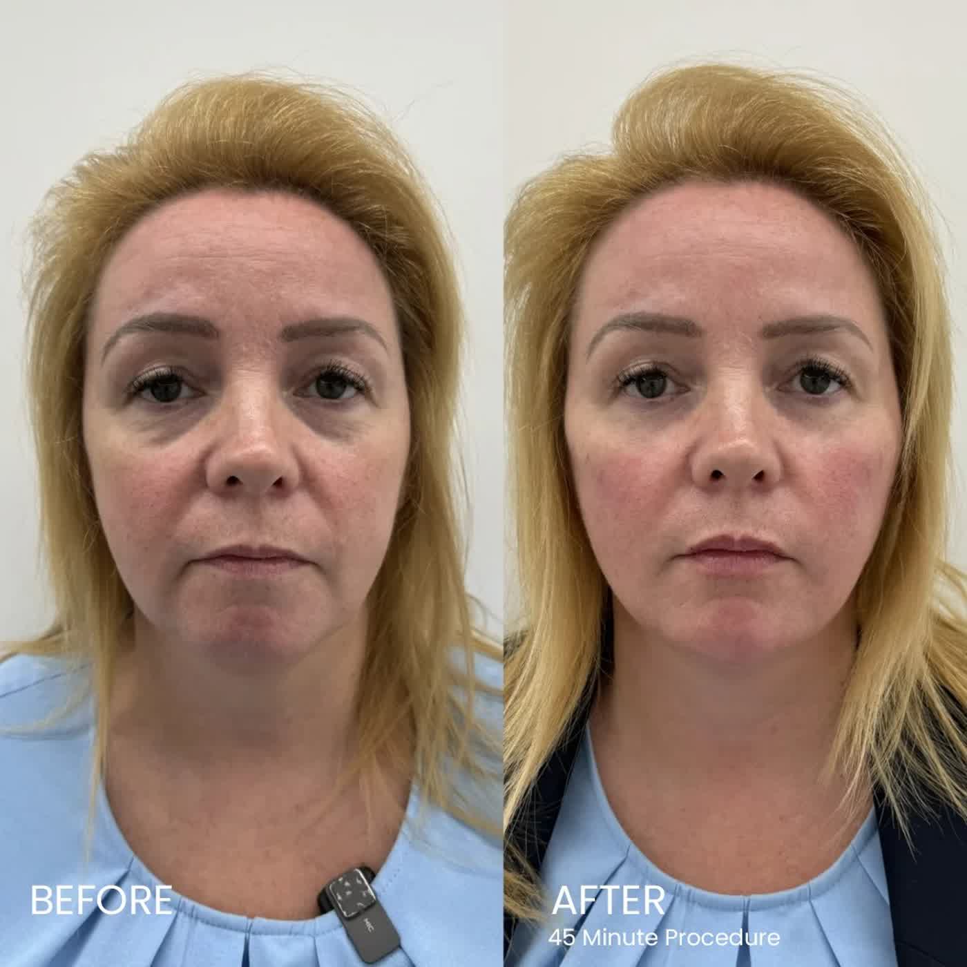 Is Golden Tree Collagen Derma Lift Netherlands het de hype waard? Eerlijke recensie