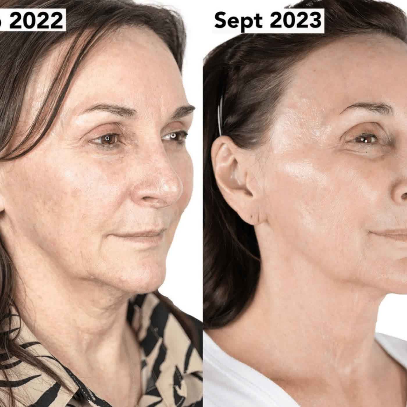 Golden Tree Collagen Derma Lift Switzerland: Warum dies das beste Kollagen-Präparat für dich ist