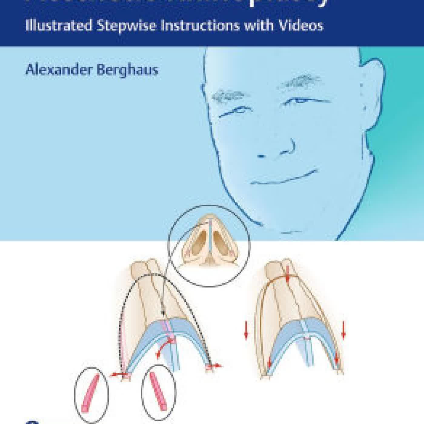 Read online: Manual of Functional and Aesthetic Rhinoplasty: Illustrated Stepwise Instructions with Videos by Alexander Berghaus