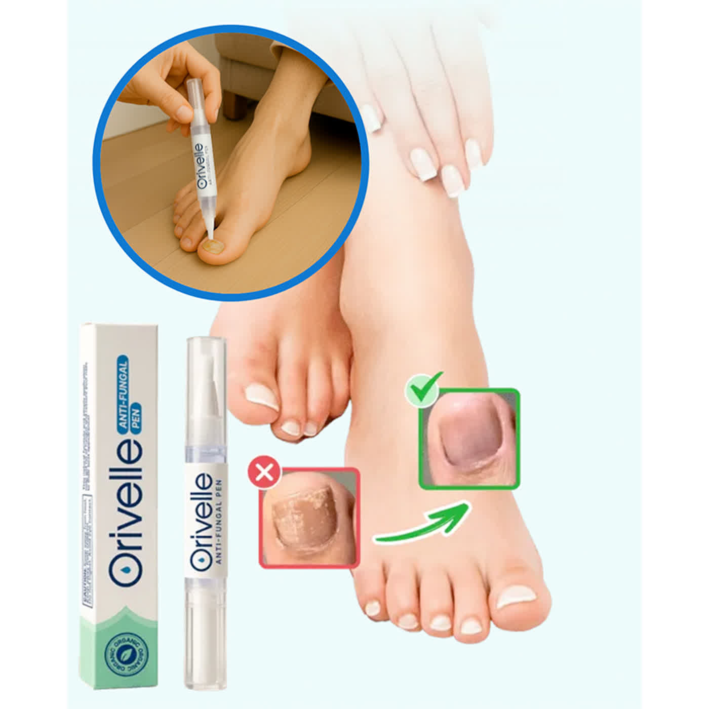 Orivelle Anti Fungal Pen: My Honest Experience with Nail Fungus Treatment